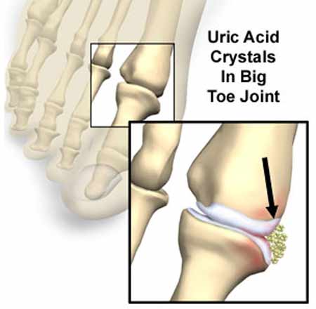 Acid uric và bệnh gout