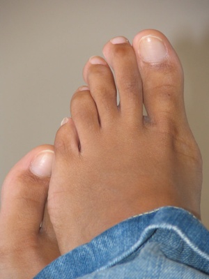 Nguồn gốc của bệnh gout